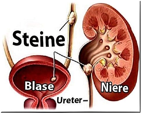 6 foods that can lead to kidney stones