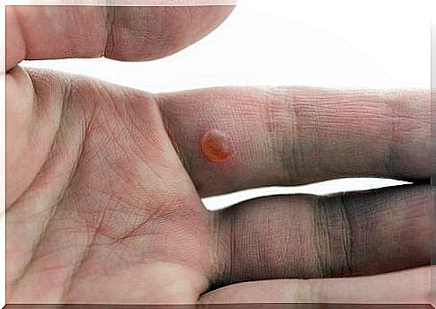 7 tips against warts