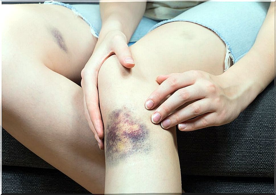 Bruising: 5 Natural Tips for Relief