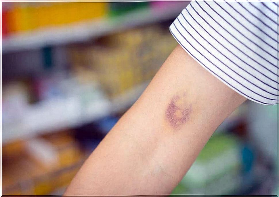 Bruise on arm