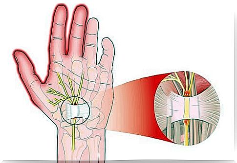 Carpal tunnel syndrome: causes and treatment