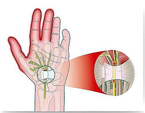 The carpal tunnel syndrome