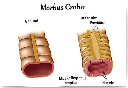 Daily diet for Crohn's disease