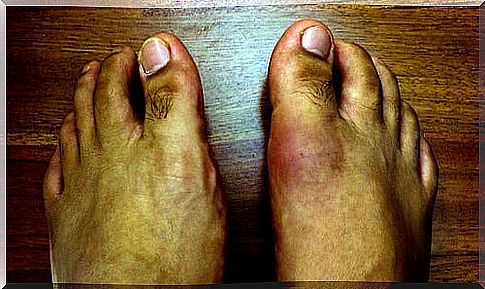 Harmful foods in gout