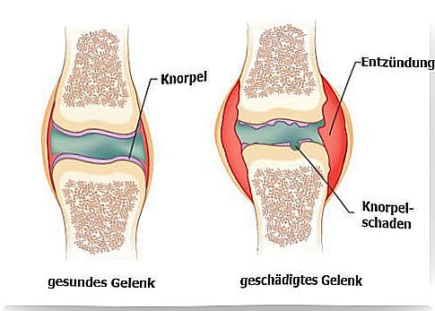 Home remedies for arthritis pain