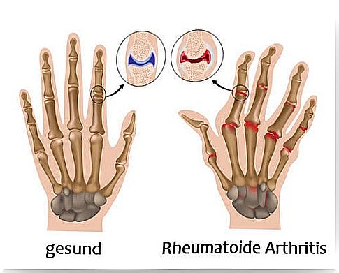 Arthritis_Rheumatism