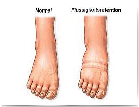 Home remedies for fluid retention