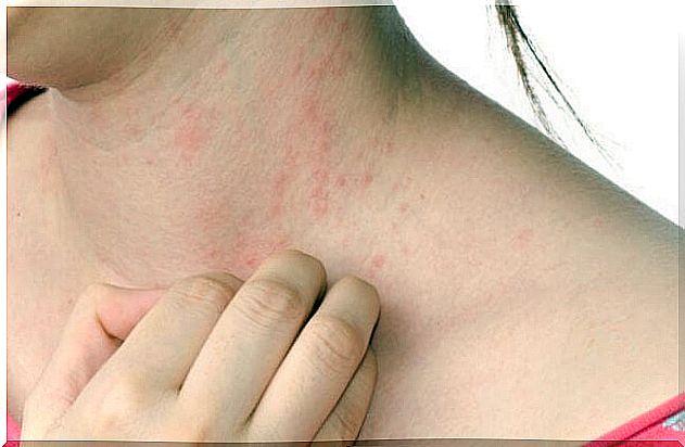 Relieve urticaria with natural remedies