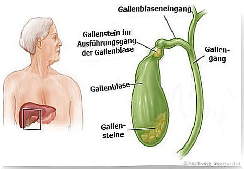 Removing gallstones naturally