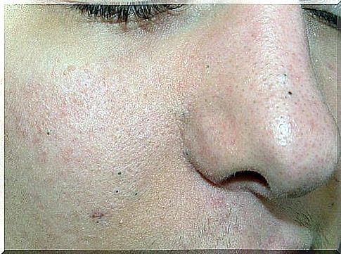 Skin problems: natural remedies for blackheads, warts and age spots