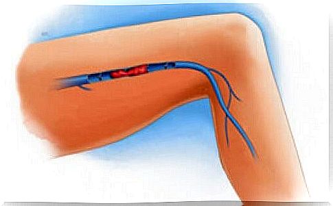 Symptoms of venous thrombosis in the legs