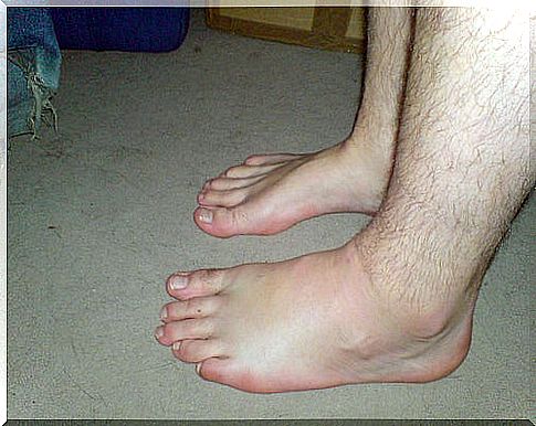 Swollen feet