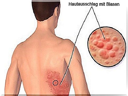 Treat herpes zoster naturally