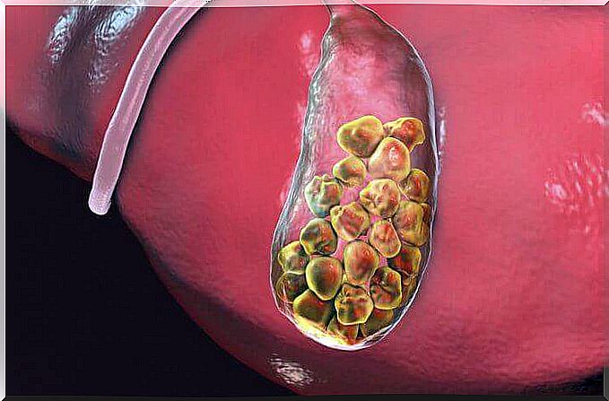 Illustration of gallstones