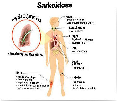 What is Sarcoid?  Symptoms and Treatment