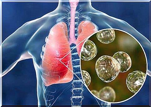 Sarcoid - pneumonia