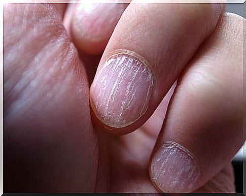 Fungal nail fingers