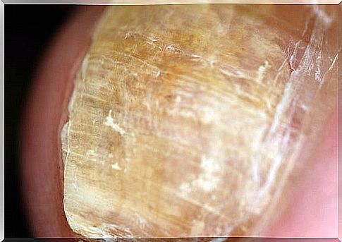 Nail fungus